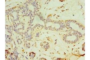 Immunohistochemistry of paraffin-embedded human breast cancer using ABIN7152819 at dilution of 1:100