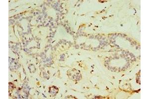 Immunohistochemistry of paraffin-embedded human breast cancer using ABIN7152819 at dilution of 1:100 (FGF6 anticorps  (AA 38-208))