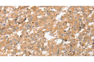 Immunohistochemistry of paraffin-embedded Human thyroid cancer using AHSG Polyclonal Antibody at dilution of 1:60