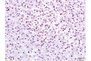 Formalin-fixed and paraffin embedded human gastric carcinoma labeled with Anti CHK2 Polyclonal Antibody, Unconjugated (ABIN685867) at 1:200 followed by conjugation to the secondary antibody and DAB staining (CHEK2 anticorps  (AA 101-250))