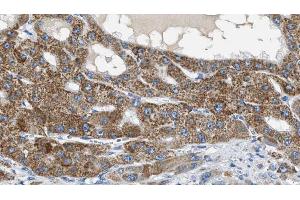 ABIN6269254 at 1/100 staining Human liver cancer tissue by IHC-P. (ZAP70 anticorps  (Internal Region))