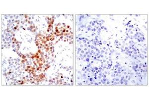 Immunohistochemical analysis of paraffin-embedded human breast carcinoma tissue using ATF2(Phospho-Thr69 or 51) Antibody(left) or the same antibody preincubated with blocking peptide(right). (ATF2 anticorps  (pThr69))