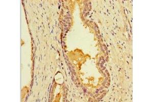 Immunohistochemistry of paraffin-embedded human prostate cancer using ABIN7158346 at dilution of 1:100 (LIMS3 anticorps  (AA 1-117))