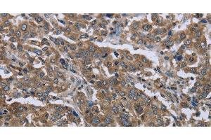 Immunohistochemistry of paraffin-embedded Human liver cancer using GGCX Polyclonal Antibody at dilution of 1:50 (GGCX anticorps)