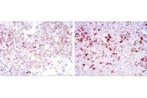 Immunohistochemical analysis of paraffin-embedded cervical cancer tissues (left) and tonsil tissues (right) using CTTN mouse mAb with DAB staining. (Cortactin anticorps)