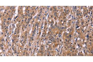 Immunohistochemistry of paraffin-embedded Human gastric cancer using SEPT7 Polyclonal Antibody at dilution of 1:50