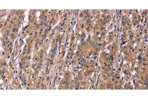 Immunohistochemistry of paraffin-embedded Human gastric cancer using SEPT7 Polyclonal Antibody at dilution of 1:50 (Septin 7 anticorps)