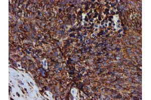 Immunohistochemical staining of paraffin-embedded Adenocarcinoma of Human breast tissue using anti-PDIA4 mouse monoclonal antibody. (PDIA4 anticorps)