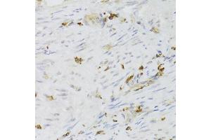 Immunohistochemistry of paraffin-embedded human adenomyosis using LSP1 Antibody (ABIN5973271) at dilution of 1/100 (40x lens). (LSP1 anticorps)