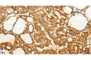 Immunohistochemistry of paraffin-embedded Human thyroid cancer tissue using FZD6 Polyclonal Antibody at dilution 1:60 (FZD6 anticorps)