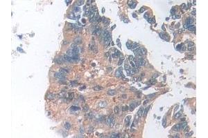 Detection of SOD2 in Human Colorectal cancer Tissue using Polyclonal Antibody to Superoxide Dismutase 2, Mitochondrial (SOD2) (SOD2 anticorps  (AA 25-222))