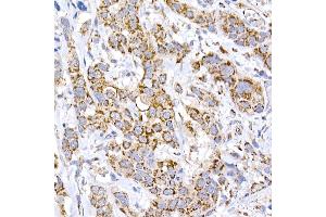 Immunohistochemistry of paraffin-embedded human esophageal cancer using MRPS15 Rabbit mAb (ABIN7268582) at dilution of 1:250 (40x lens). (MRPS15 anticorps)