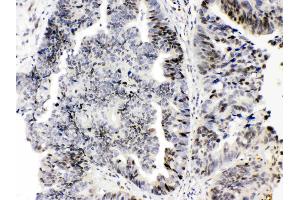 E2F4 was detected in paraffin-embedded sections of human intetsinal cancer tissues using rabbit anti- E2F4 Antigen Affinity purified polyclonal antibody (Catalog # ) at 1 µg/mL. (E2F4 anticorps  (N-Term))