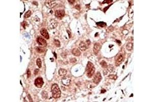 IHC analysis of FFPE human breast carcinoma tissue stained with the SUMO2 antibody