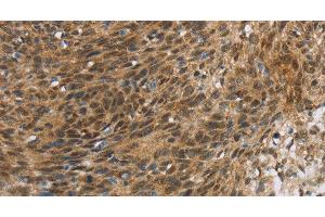 Immunohistochemistry of paraffin-embedded Human cervical cancer tissue using FOXB1 Polyclonal Antibody at dilution 1:30 (FOXB1 anticorps)