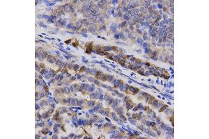 Immunohistochemistry of paraffin-embedded human thyroid cancer using SNCG antibody at dilution of 1:200 (x400 lens) (SNCG anticorps  (AA 1-127))