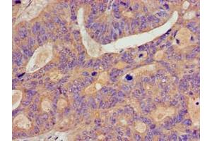 Immunohistochemistry of paraffin-embedded human colon cancer using ABIN7145766 at dilution of 1:100