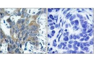 Immunohistochemistry analysis of paraffin-embedded human breast carcinoma, using Catenin-beta (Phospho-Ser33) Antibody. (beta Catenin anticorps  (pSer33))