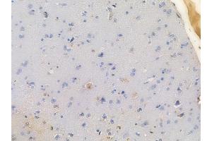 ABIN6260371 and ABIN6279543 at 1/100 staining human glioblastoma by IHC-P.