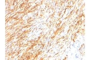 Formalin-fixed, paraffin-embedded human Schwanoma stained with GFAP antibody (GA-5 + ASTRO/789). (GFAP anticorps)