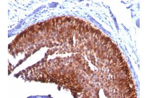 Formalin-fixed, paraffin-embedded human Bladder Carcinoma stained with CK17 Mouse Monoclonal Antibody (KRT17/778). (KRT17 anticorps)