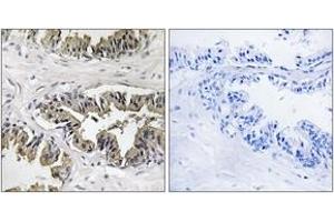 Immunohistochemistry analysis of paraffin-embedded human prostate carcinoma tissue, using GSPT1 Antibody. (GSPT1 anticorps  (AA 101-150))