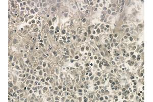 ABIN6255665 and ABIN6268972 at 1/100 staining human non-Hodgkin lymphoma by IHC-P. (Cyclin H anticorps  (pThr315))