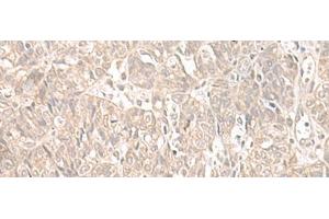 Immunohistochemistry of paraffin-embedded Human ovarian cancer tissue using ILKAP Polyclonal Antibody at dilution of 1:55(x200)