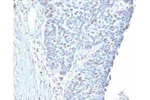 Formalin-fixed, paraffin-embedded human Endometrial Carcinoma stained with Cyclin A2 Mouse Monoclonal Antibody (CCNA2/2333). (Cyclin A anticorps)