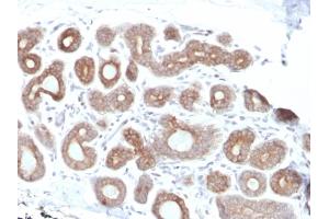 Formalin-fixed, paraffin-embedded human Breast Carcinoma stained with Calpain 1 Mouse Monoclonal Antibody (CAPN1/1530). (CAPNL1 anticorps)