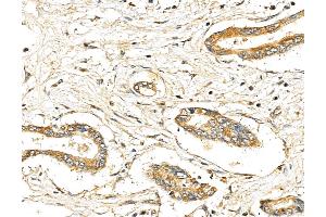 ABIN7094342 and ABIN7098389 at 1/100 staining Human pancreatic cancer by IHC-P. (LIN7C anticorps  (Internal Region))