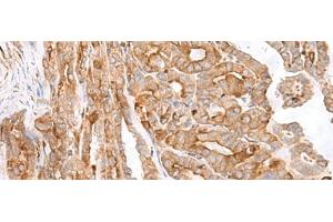 Immunohistochemistry of paraffin-embedded Human thyroid cancer tissue using MCAM Polyclonal Antibody at dilution of 1:40(x200) (MCAM anticorps)