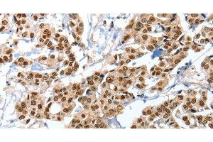 Immunohistochemistry of paraffin-embedded Human breast cancer tissue using ANXA10 Polyclonal Antibody at dilution 1:35 (Annexin a10 anticorps)