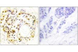 Immunohistochemistry analysis of paraffin-embedded human breast carcinoma, using ERK3 (Phospho-Ser189) Antibody. (MAPK6 anticorps  (pSer189))