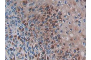 IHC-P analysis of Human Skin cancer Tissue, with DAB staining. (CCL3L1 anticorps  (AA 1-93))