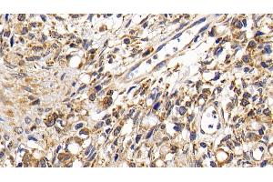 Detection of CTSK in Human Ovarian cancer Tissue using Polyclonal Antibody to Cathepsin K (CTSK)