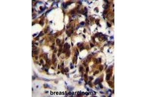 TRADD Antibody (Center) immunohistochemistry analysis in formalin fixed and paraffin embedded human breast carcinoma followed by peroxidase conjugation of the secondary antibody and DAB staining.