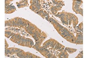 The image on the left is immunohistochemistry of paraffin-embedded Human colon cancer tissue using ABIN7131118(SNAP91 Antibody) at dilution 1/20, on the right is treated with fusion protein. (SNAP91 anticorps)