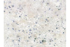 ABIN6255723 and ABIN6267298 at 1/100 staining human astrocytoma by IHC-P. (APP anticorps  (pThr668, pThr743))