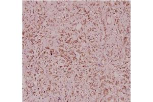 Immunohistochemistry analysis of Defensin alpha-3 Antibody in paraffin-embedded human breast carcinoma tissue at 1/100. (DEFa3 anticorps)