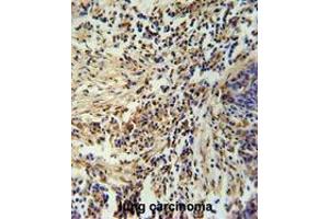 ZNF720 Antibody (Center) immunohistochemistry analysis in formalin fixed and paraffin embedded human lung carcinoma followed by peroxidase conjugation of the secondary antibody and DAB staining. (ZNF720 anticorps  (Middle Region))