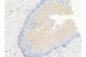 ABIN6256156 and ABIN6267546 at 1/100 staining human cervical carcinoma by IHC-P. (VASP anticorps  (pSer157))
