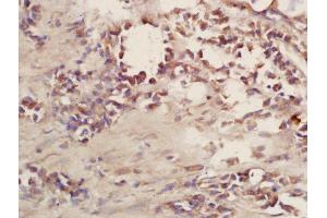Formalin-fixed and paraffin embedded human lung carcinoma labeled with Rabbit Anti-CD101 Polyclonal Antibody, Unconjugated (ABIN2172703) at 1:200 followed by conjugation to the secondary antibody and DAB staining (CD101 anticorps  (AA 51-150))