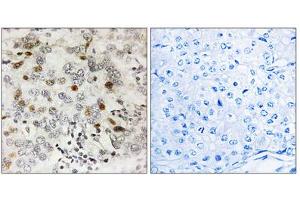 Immunohistochemistry analysis of paraffin-embedded human breast carcinoma tissue using CGREF1 antibody. (CGREF1 anticorps  (C-Term))