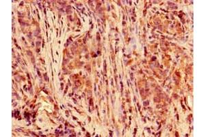 Immunohistochemistry of paraffin-embedded human pancreatic cancer using ABIN7150430 at dilution of 1:100 (POLR2C anticorps  (AA 2-275))