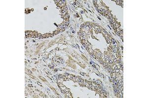 Immunohistochemistry of paraffin-embedded human prostate using TMC1 antibody (ABIN6134923, ABIN6149240, ABIN6149242 and ABIN6224704) at dilution of 1:100 (40x lens). (TMC1 anticorps  (AA 600-700))