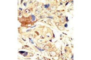 Formalin-fixed and paraffin-embedded human cancer tissue reacted with the primary antibody, which was peroxidase-conjugated to the secondary antibody, followed by AEC staining. (EGFR anticorps  (N-Term))