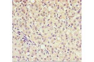 Immunohistochemistry of paraffin-embedded human liver cancer using ABIN7143586 at dilution of 1:100 (AKR7A2 anticorps  (AA 100-359))