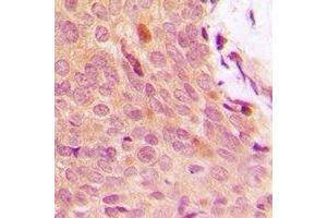Immunohistochemical analysis of IKB alpha (pY42) staining in human breast cancer formalin fixed paraffin embedded tissue section.