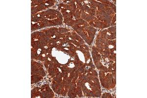 Immunohistochemical analysis of paraffin-embedded human colon carcinoma tissue using (ABIN392864 and ABIN2842279) performed on the Leica® BOND RXm.